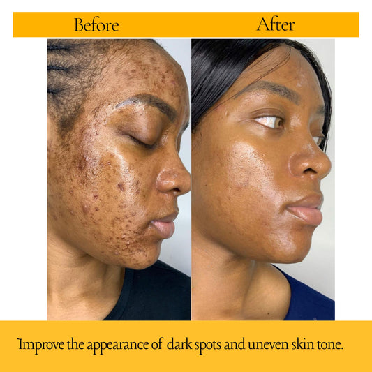 Turmeric Brightening Serum, Dark Spots Remover, Smooth & Even Skin Tone 1fl oz